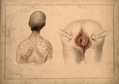 The diseased back and neck of a woman, shown beside a detail of diseased tissue around the anus of her young son