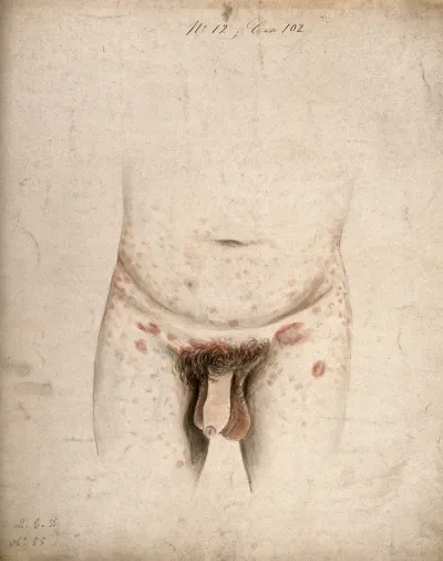 The diseased genitals, groin, abdomen and upper legs of a man suffering from syphilis roseola