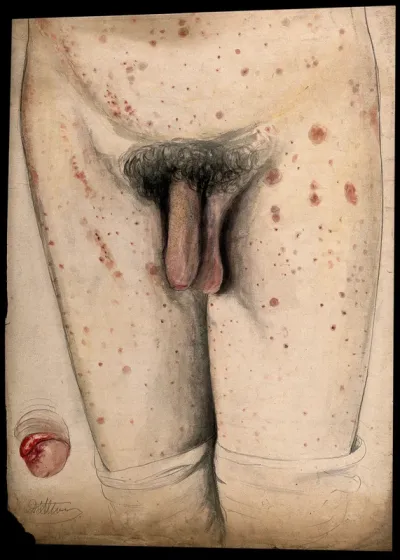 The diseased genitals, legs and abdomen of a man, with a detail showing the penis