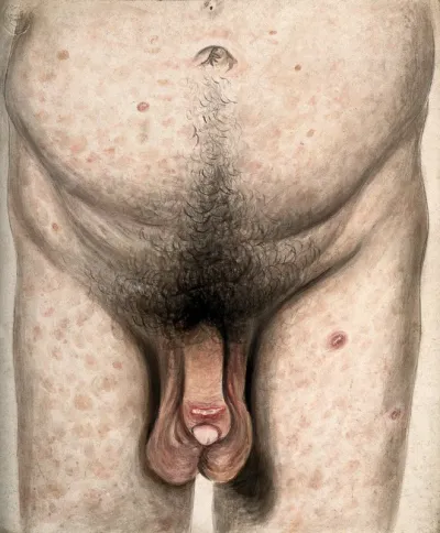 The diseased penis, abdomen and legs of a man