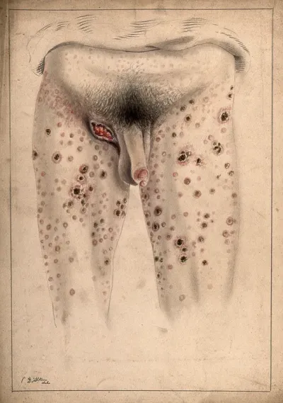 The diseased penis and legs of a man, with an open wound in the groin area