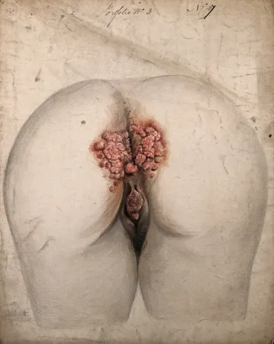 The diseased tissue around the anus and genitals of a woman, as seen from behind