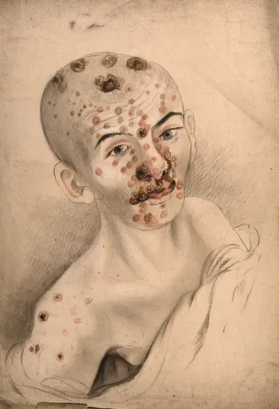 The face and shoulders of a woman, displaying sores and abcesses: the woman's head has been shaven