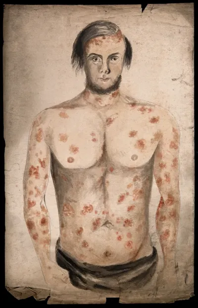 The face, arms and torso of a man suffering from diseased skin and abcesses (?)