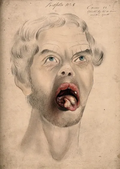 The face of a man suffering from cancer of the tongue, showing diseased tissue on the tongue