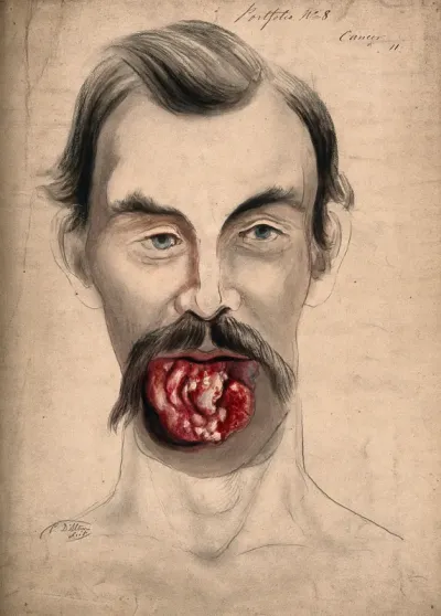 The face of a man suffering from cancer of the tongue, showing severely diseased tissue on the tongue