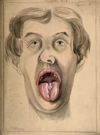 The face of a man suffering from syphilis, shown with mouth open wide, displaying areas of diseased tissue on the tongue and upper lip