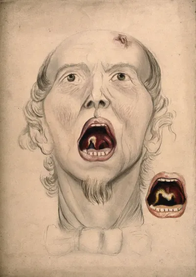 The face of a man, with mouth open wide, displaying a diseased area of tissue on the soft palate and uvula: includes a detail showing the progression of the disease in the mouth eleven days later