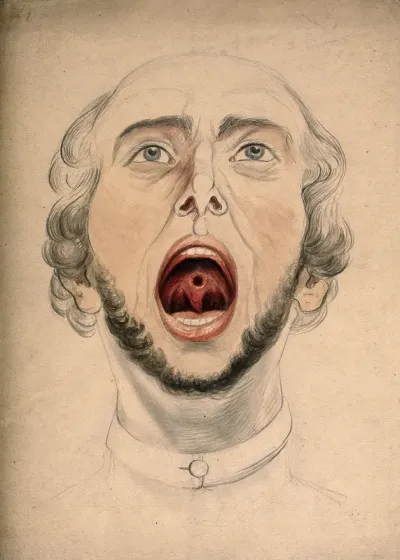 The face of a man, with mouth open wide, displaying a hole or area of diseased tissue on the soft palate, above the uvula