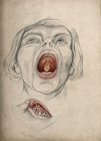 The face of a man, with mouth open wide, displaying diseased areas of tissue on the soft palate and uvula: includes a detail showing additional areas of disease on the patient's gum and upper lip