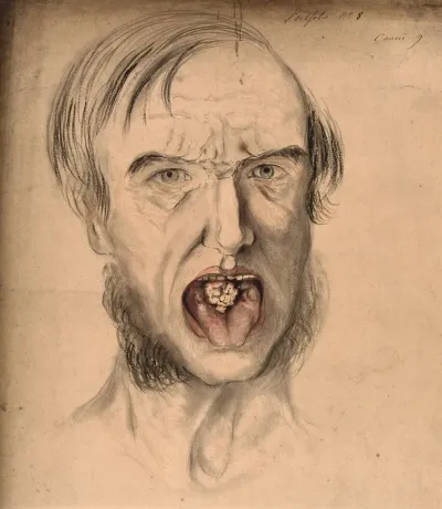 The face of a man with mouth open wide, displaying the symptoms of cancer, with an area of diseased tissue seen on the tongue