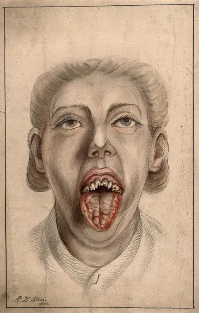 The face of a woman with her mouth open, displaying diseased tissue on the tongue and broken teeth