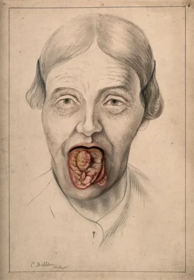 The face of a woman with her mouth open, displaying severely diseased tissue on the tongue