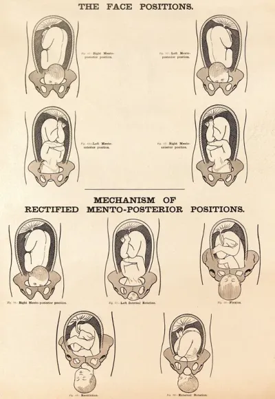The face positions and the mechanism of rectified mento-posterior positions in childbirth