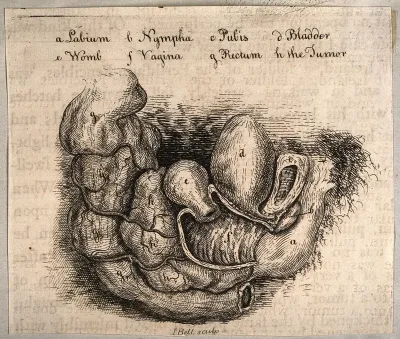 The female reproductive and urinary systems with a tumor