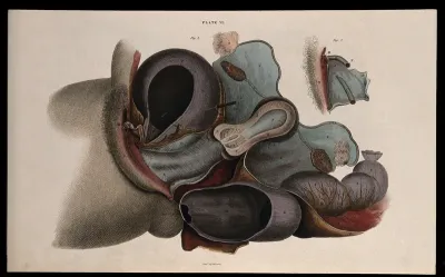 The female reproductive system: dissection showing the uterus, ovaries and fallopian tubes, the intestines and bladder, with a detail showing the clitoris