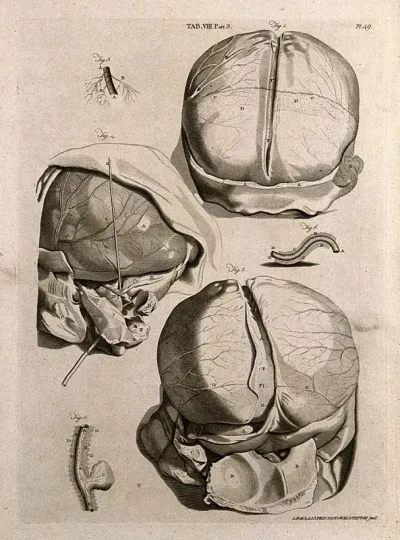 The head of a man with the meninges around the brain exposed