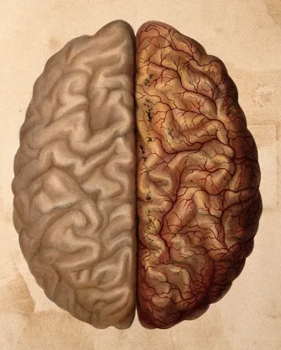 The human brain: the cerebral gyri seen from above, the right hemisphere covered with pia mater