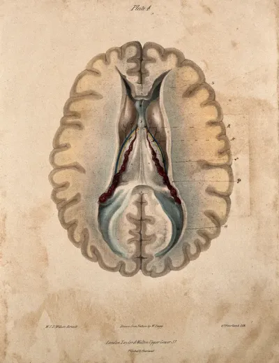 The human brain: the lateral ventricles