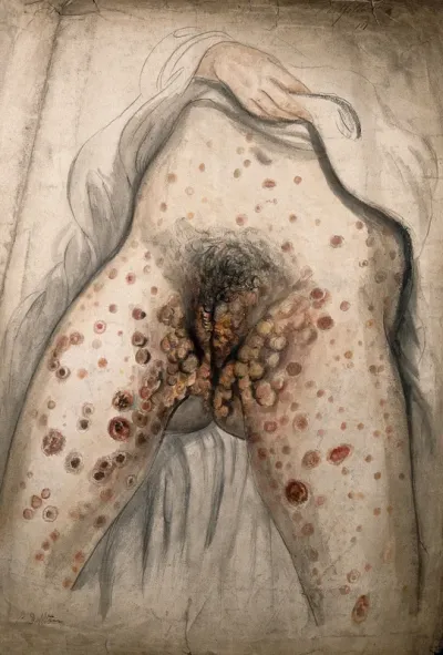 The lower half of a woman (seen from the waist down with her hand lifting up her garment) with her legs apart to show severely diseased genitals and sores all over the exposed parts of her body