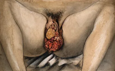 The lower half of a woman with legs apart to show severely diseased genital tissue