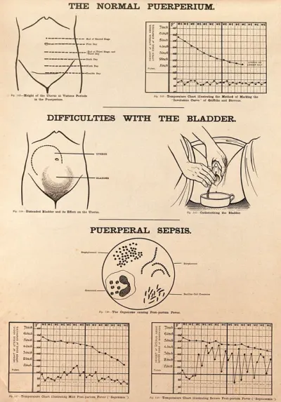 The normal puerperium, post-partum difficulties with the bladder, and puerperal sepsis
