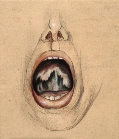 The open mouth of a man suffering from diseased tissue on the soft palate and uvula