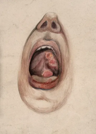 The open mouth of a man suffering from syphilis, showing diseased tissue under the tongue (?)