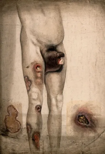The severely diseased and swollen scrotum and legs of a man, with details showing diseased areas of skin on the leg and shoulder