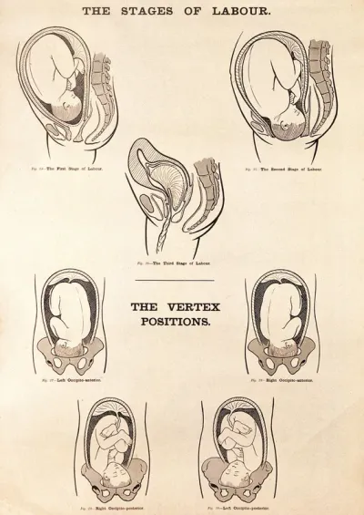 The stages of labour and the vertex positions