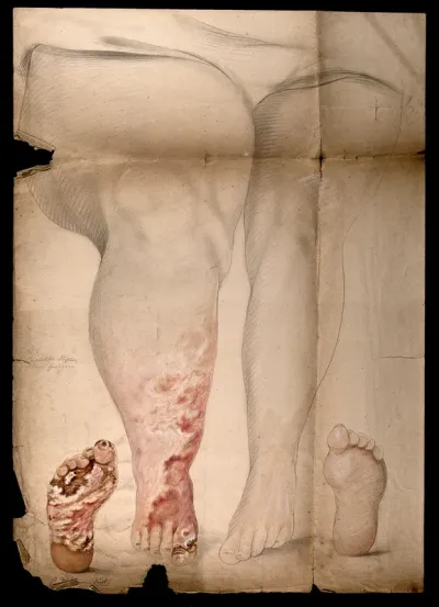 The swollen legs and the damaged feet of a woman with disease diagnosed as syphilis
