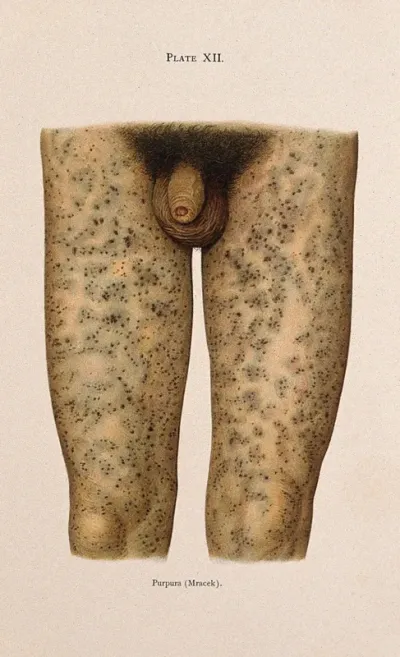 The thighs and genitals of a man suffering from purpura