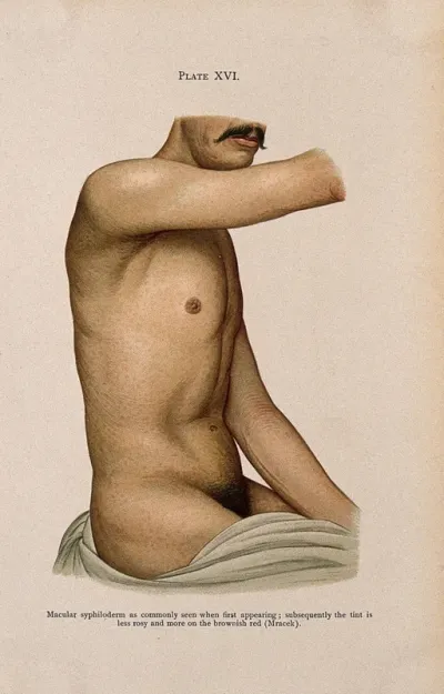 The torso and arm of a man suffering from syphilis, showing a rash of macular syphiloderm