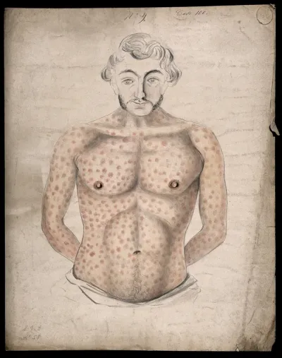 The torso and arms of a man suffering from a rash of sores