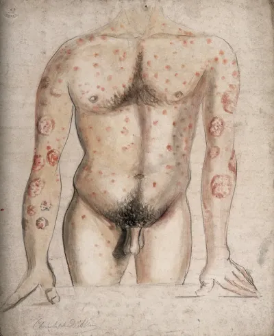 The torso and arms of a man suffering from abcesses (?) and diseased areas of skin