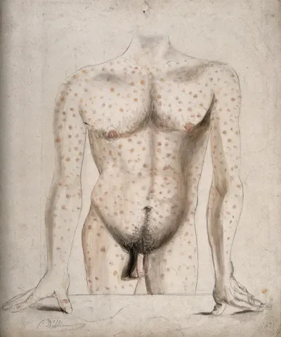 The torso, arms and upper thighs of a man suffering from a rash of sores