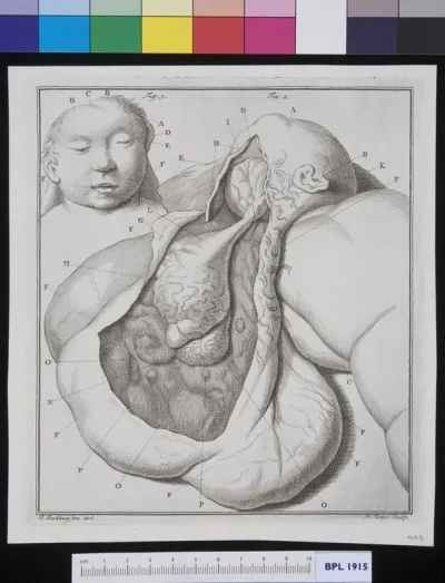 The tumor from the child's head dissected