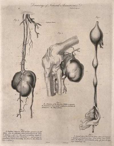 Three examples of aneurisms with surrounding arteries, lettered for key