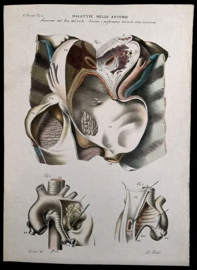 Three examples of diseased arteries of the heart, numbered for key