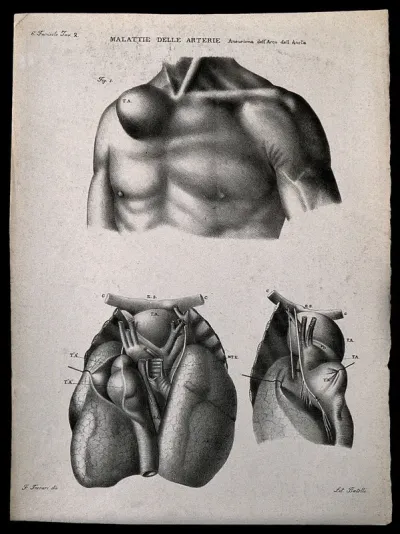 Three examples of diseased blood vessels of the heart, numbered for key