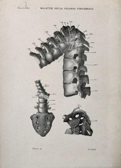 Three examples of diseased spine, numbered for key