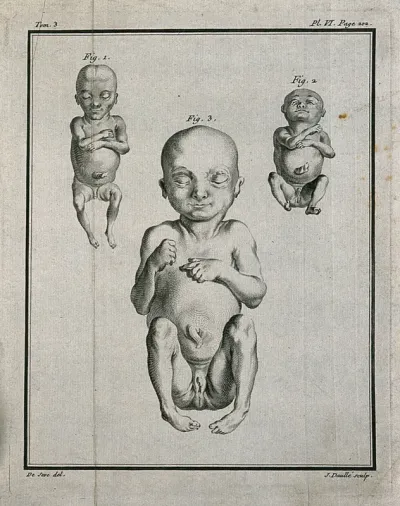 Three figures of foetuses with hermaphroditic genitals