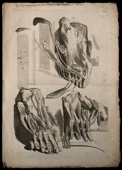 Three figures of the muscles of the foot, showing the sole of the foot progressively dissected
