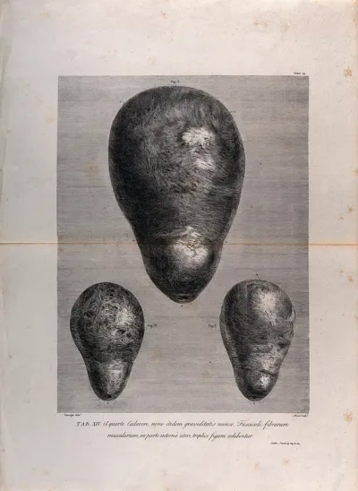 Three figures showing the muscular fasciculi on the inside of the pregnant uterus at nine months