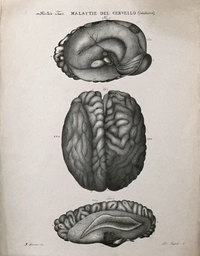 Three sections of diseased brain, numbered for key