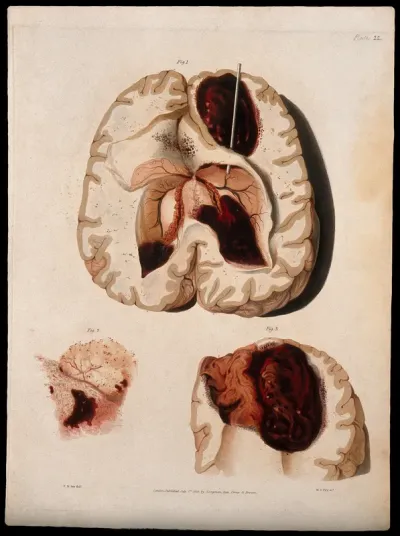 Three sections of diseased brain