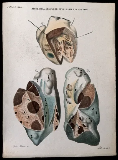 Three sections of diseased heart and lungs showing blood clots and haemorrhage, numbered for key