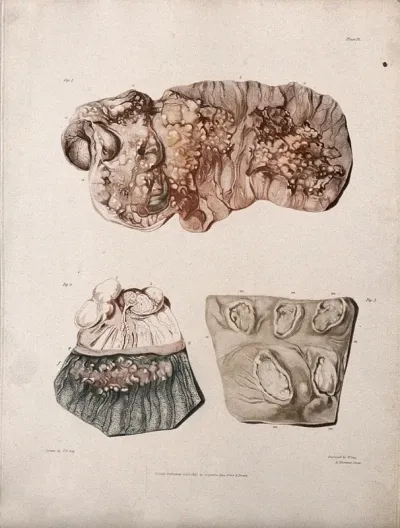 Three sections of diseased intestines