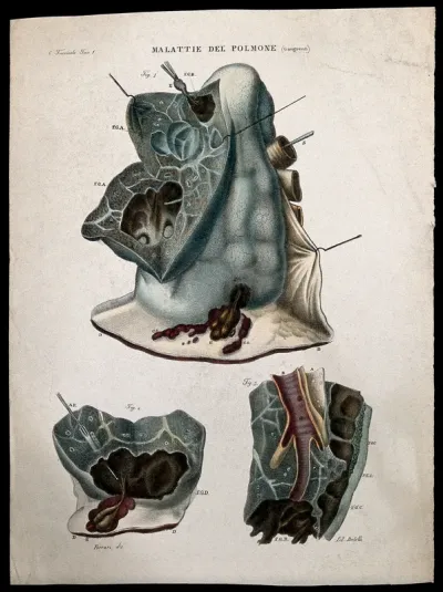 Three sections of diseased lungs, numbered for key