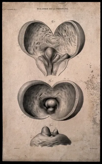 Three sections of diseased prostate, numbered for key